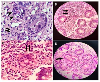 Immune dysregulation due to bi-allelic mutation of the actin remodeling protein DIAPH1